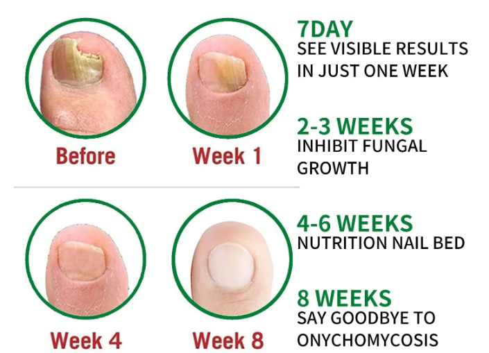 ⭐TRATAMIENTO PARA HONGOS SEVEN DAYS NAIL FUNGUS👨‍⚕️